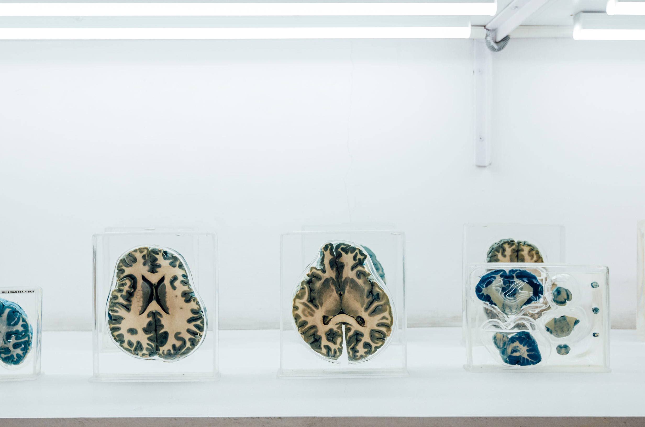 Blain slices on display with special staining techniques that differentially colour the grey and white matter of the brain (Developed by-Mulligan, 1931) and various tracts (connections). Blain slices on display with special staining techniques that differentially colour the grey and white matter of the brain (Developed by-Mulligan, 1931) and various tracts (connections).